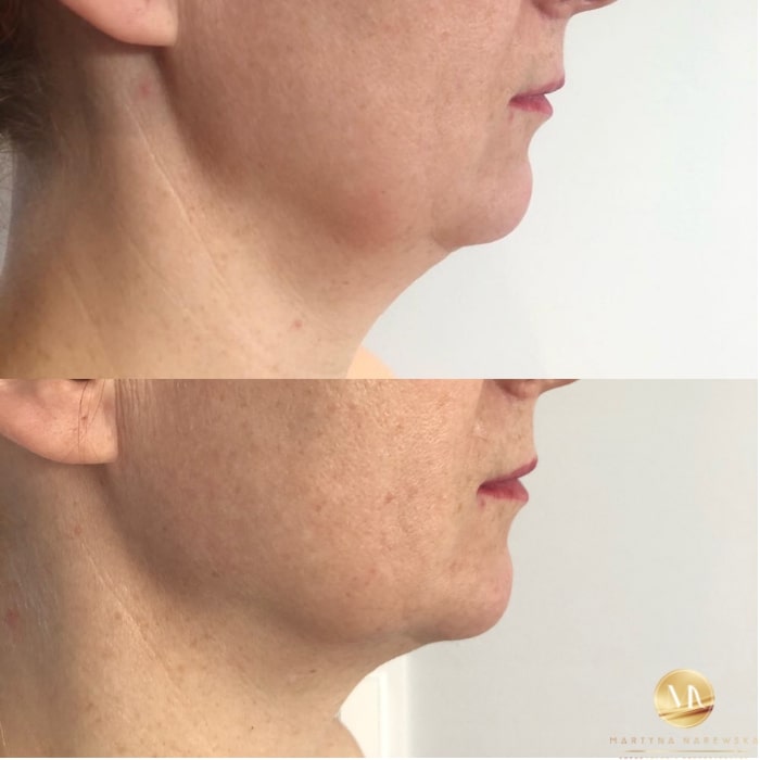 Podbródek kobiety z prawego profilu przed i po zabiegu hifu 3d